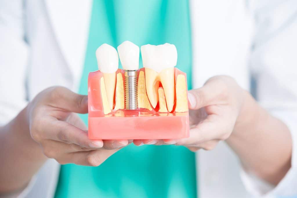 Can Dental Implants Be