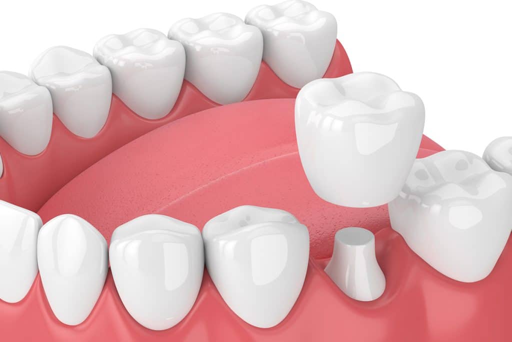 How Much Does a Dental Crown Cost in Fort Collins, CO?