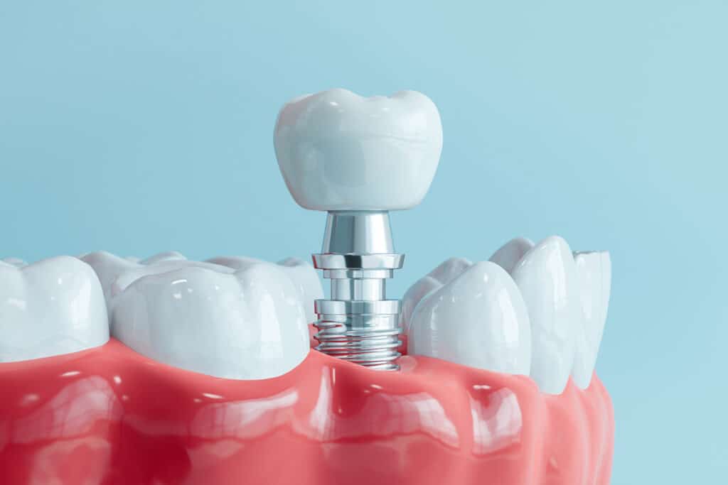 Single Tooth Implant Cost vs. Bridge Cost: Which Is More Cost-Effective?